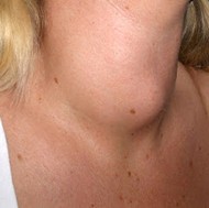 woman with a goiter